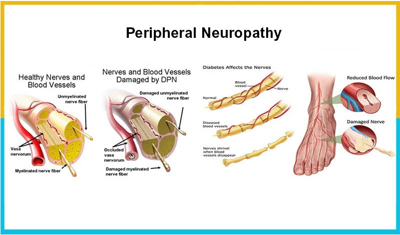 Ischemia – The Primary Cause of Peripheral Sensory Neuropathy ...