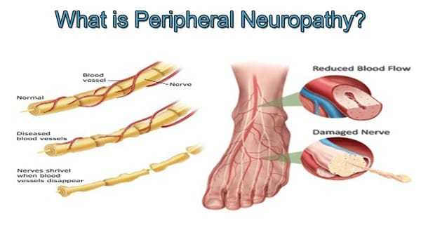 qu-es-la-neuropat-a-perif-rica-neuropathy-relief-miami