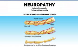 Neuropathy Relief Miami. Dr. Alfonso (Centro de Alivio de la Neuropatía de Miami) Protocolo de Tratamiento. Afortunadamente, el alivio es posible y uno de los tratamientos más prometedores está disponible en Miami a través de la experiencia del Dr. Alfonso.